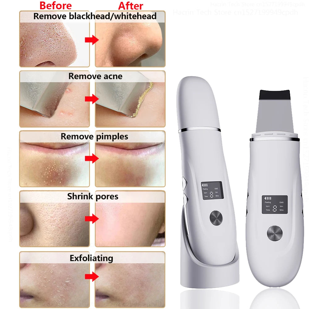 Ultrasonic Peeling Remover Blackhead Facial Skin Scrubber Facial Shovel Deep Cleaning Face Lifting Removal Pore Acne EMS Lift