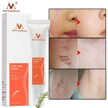 Achieve Clear and Smooth Skin with Acne Removal Face Cream - Charm Trove