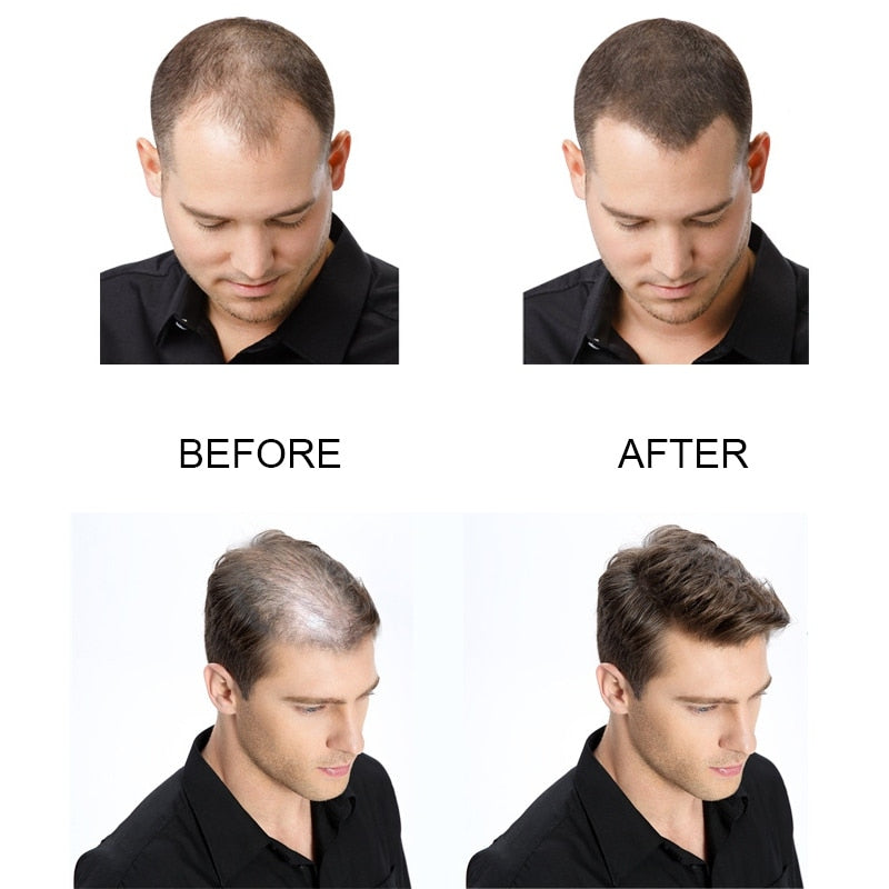 PURC Hair Growth Oil Fast Hair Growth Products Scalp Treatments Prevent Hair Loss Thinning Beauty Hair Care for Men Women 20ml
