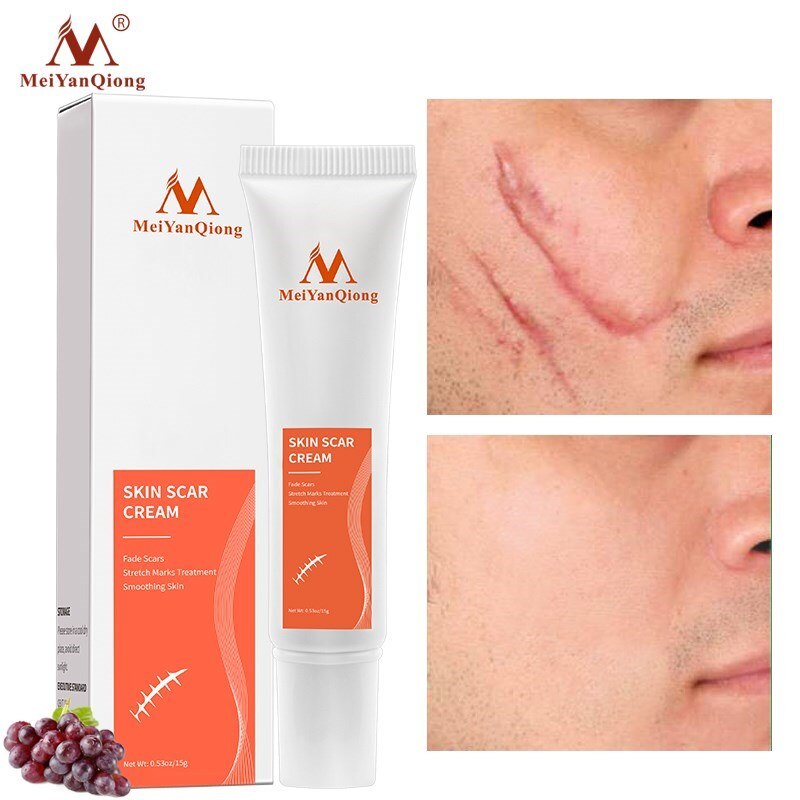 Achieve Clear and Smooth Skin with Acne Removal Face Cream