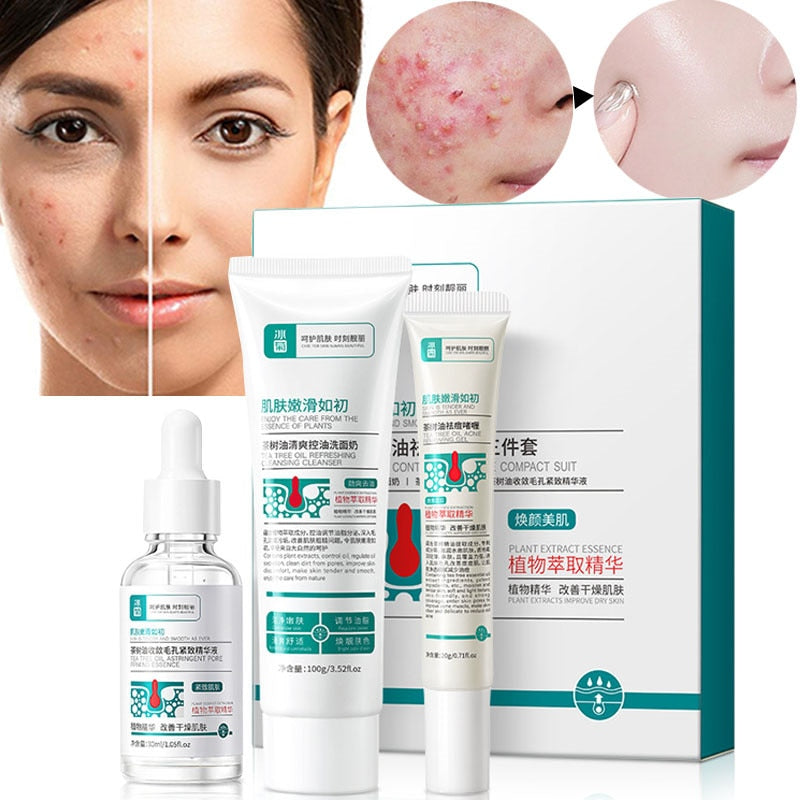 Clear Your Skin with Acne Removal Cream Treatment Set